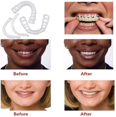 Close-up of adjustable bite aligners for upper and lower teeth