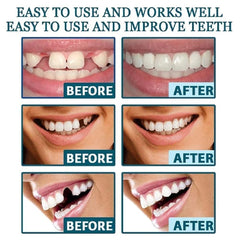User-friendly whitening kit easy to apply after cleaning