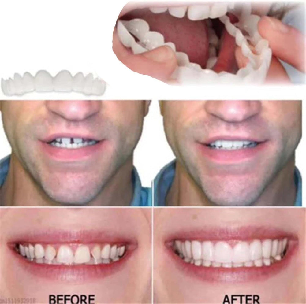 Smile aligners displayed with clear natural white color