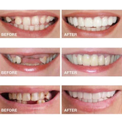 Cosmetic smile enhancers in boiled-water molding setup
