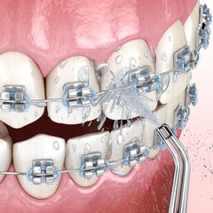 ZACCER Periodontal Tip Replacement for Water Flosser