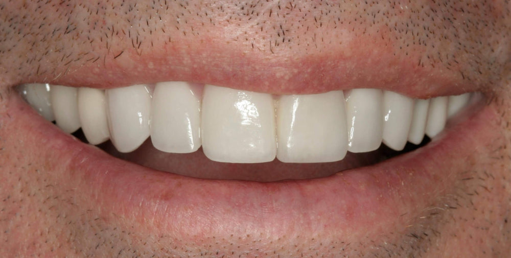 Affordable home denture solution
