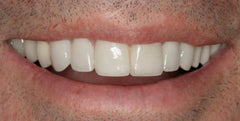 Affordable home denture solution