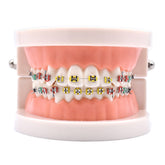 Angzhili orthodontic demonstration model with metal brackets and color ligature ties