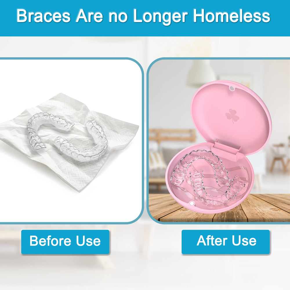 Open ARGOMAX aligner case showing interior space