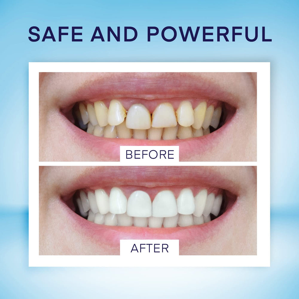 Close-up of whitening pen tip applying gel to tooth
