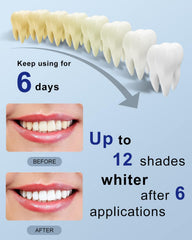At-home whitening setup with MySmile kit