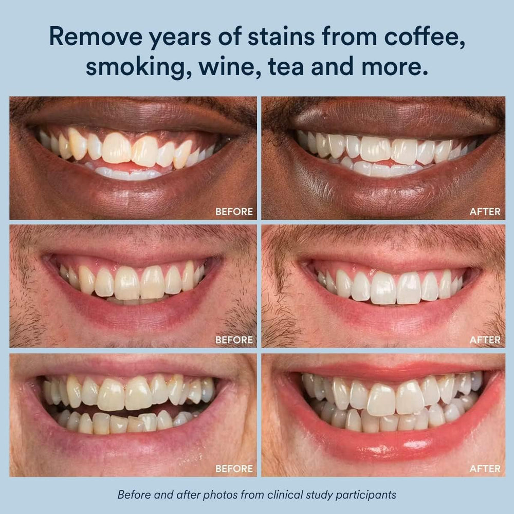 28 whitening strips across 14 treatments