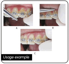 Single-use orthodontic wire device non-sterile packaging