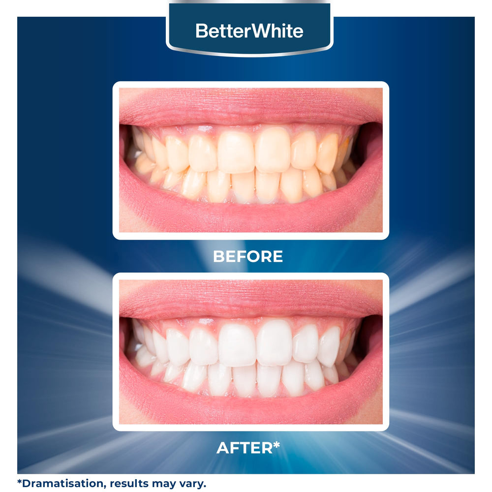 Bright smile showcasing whiter teeth after using BetterWhite