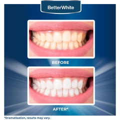 Bright smile showcasing whiter teeth after using BetterWhite