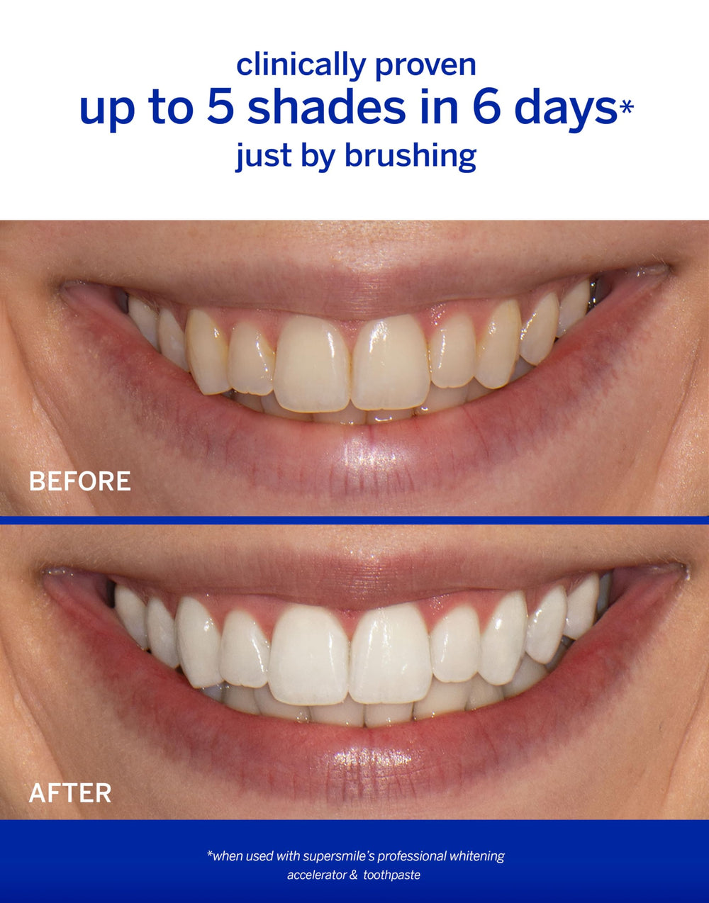 Calprox enamel restoration with nano-hydroxyapatite illustration