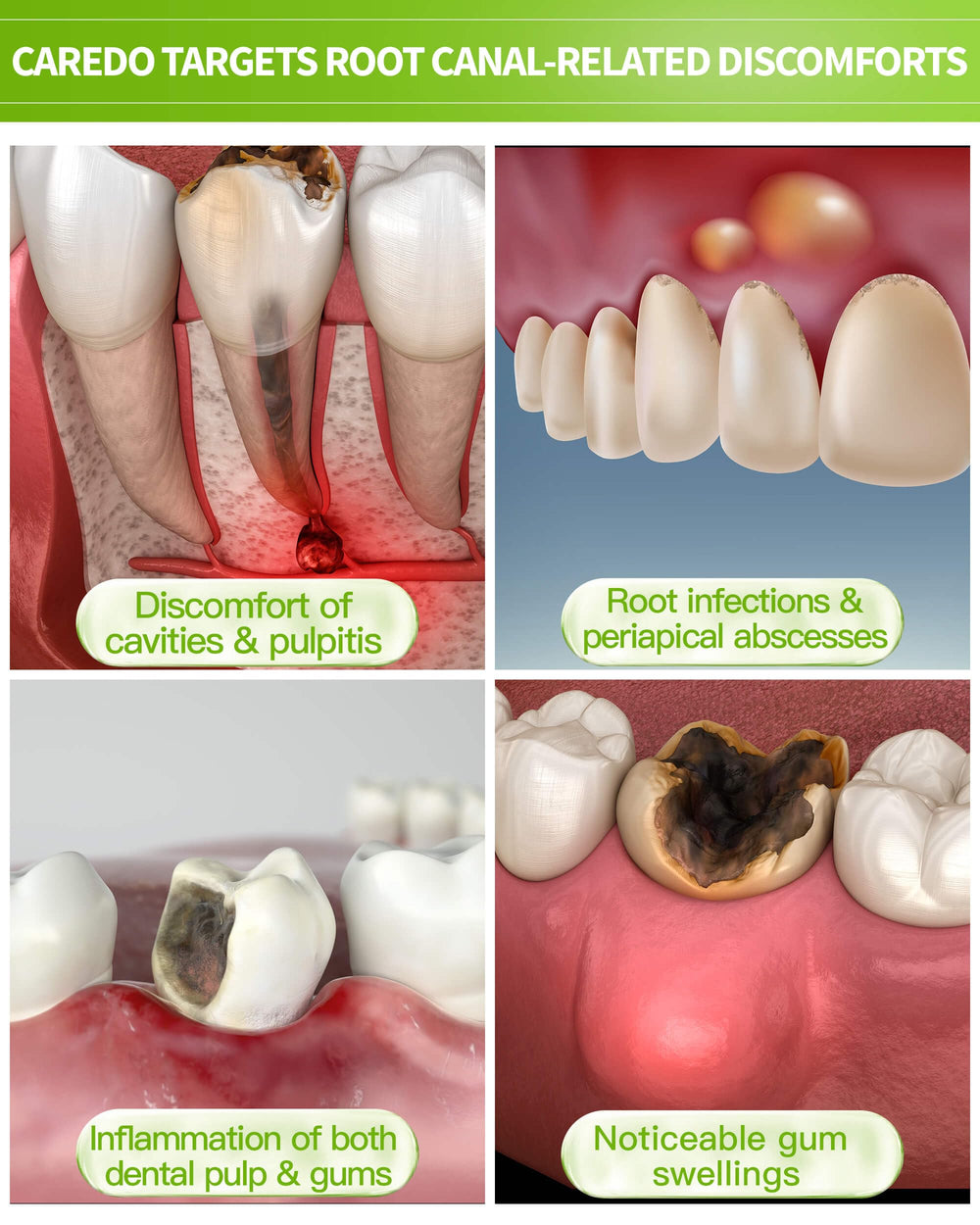 Root canal comfort and pulp protection toothpaste