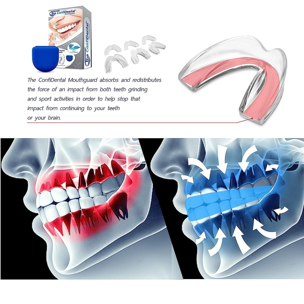 Boil-and-bite molding instructions for ConfiDental night guards