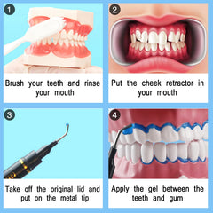 Gingival protection gel applied to gums during teeth whitening
