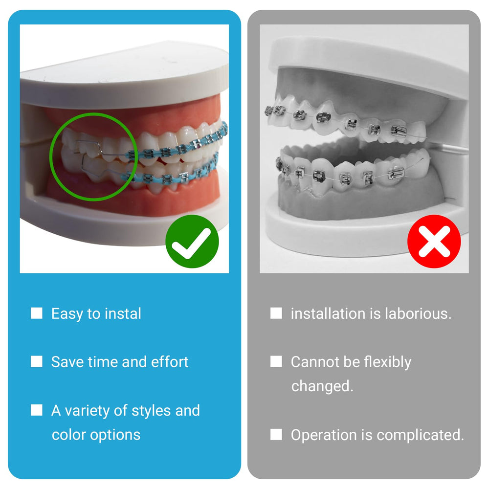 Blue retainer attached to an orthodontic dental mold.