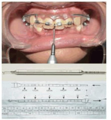 Dontrix gauge in orthodontic application demonstration