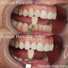 Gentle whitening for sensitive teeth with enamel-safe formula