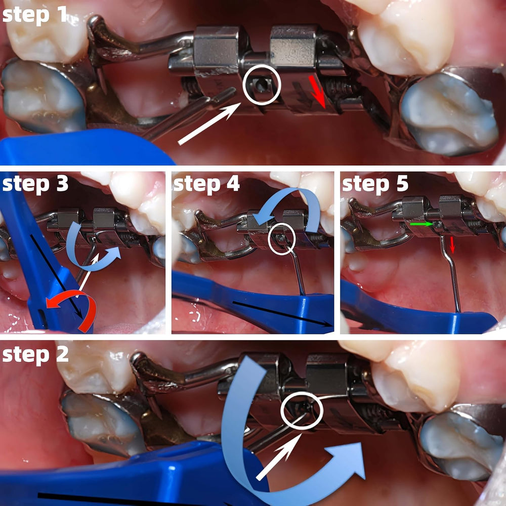 Rotation and adjustment of expansion implants illustrated