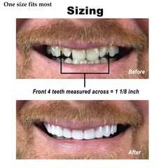 Natural-looking upper veneer applied for a discreet smile