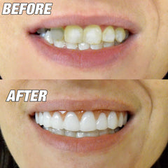 Close-up of a natural-looking lower smile