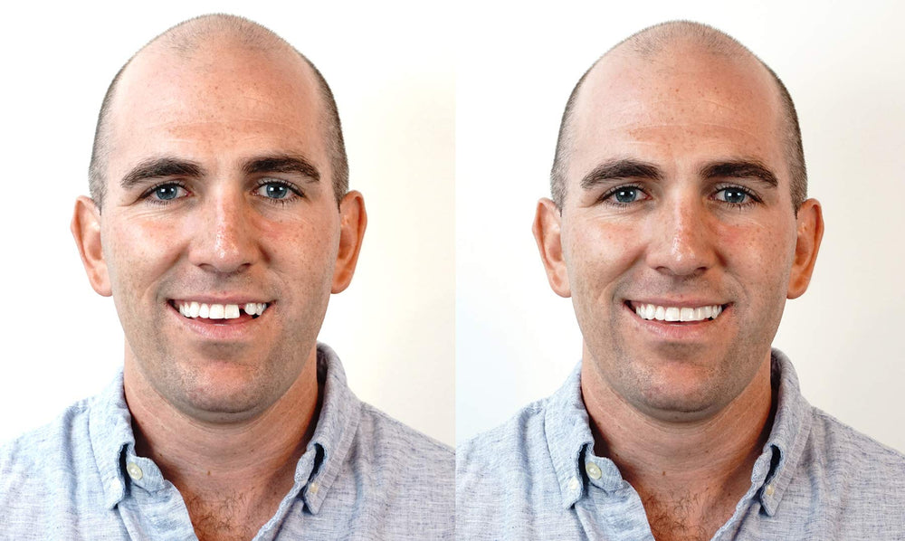 Three shade options and 9 molded teeth displayed for fast replacement