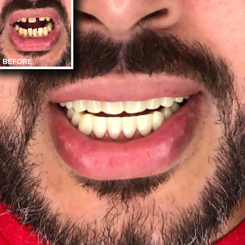Fitting guide: upper teeth first then lower for best aesthetic result