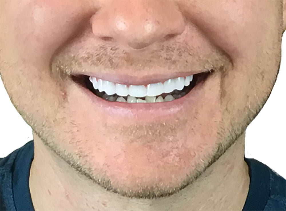 Side view of Instant Smile Flex 2pk showing slim profile