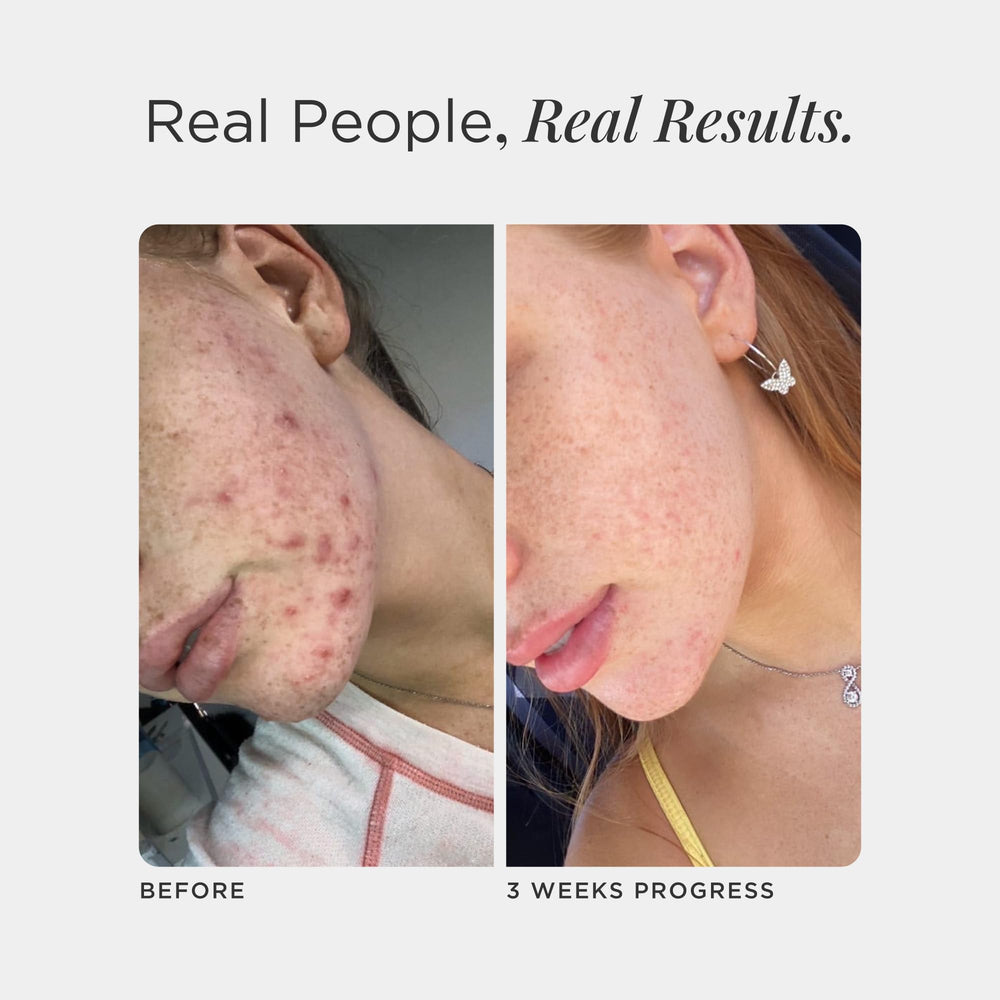 Lifestyle shot of a person with clear skin representing acne support