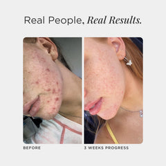 Lifestyle shot of a person with clear skin representing acne support