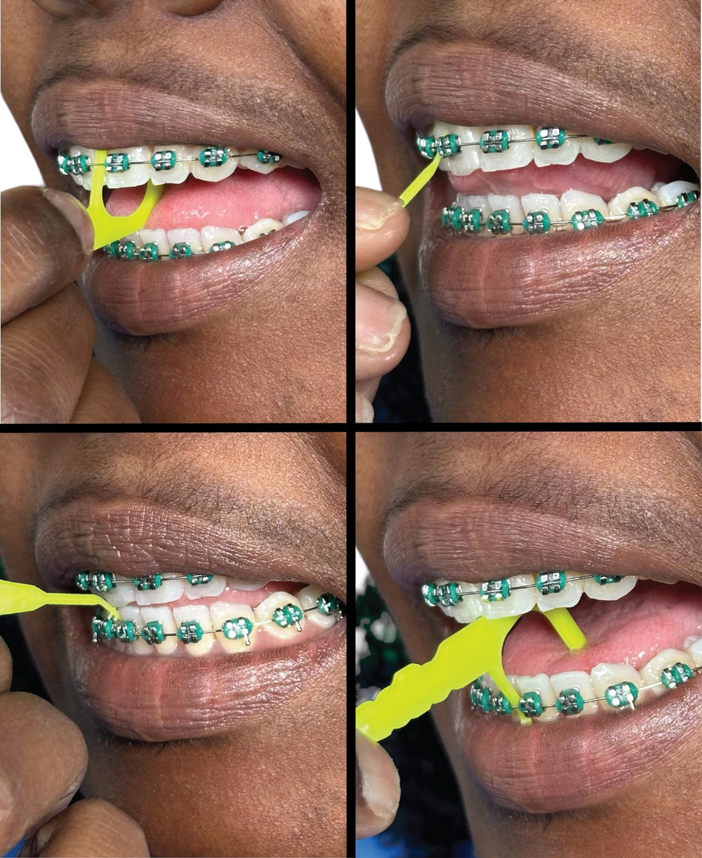 Flosser for braces designed to fit under the arch wire