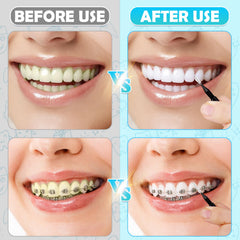 Interdental brushes for orthodontic care