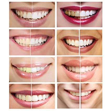 Boil-and-bite mouth trays included for teeth whitening