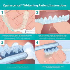Opalescence 10% gel applied to whitening tray
