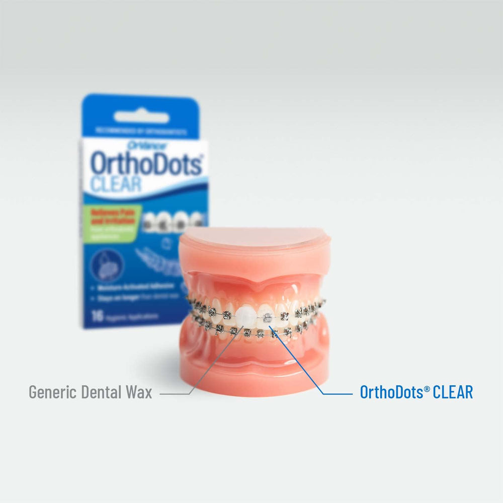 Applying OrthoDots to braces and clear aligners