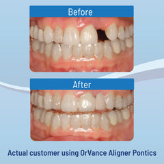 16-count OrVance Aligner Pontics box with shading detail