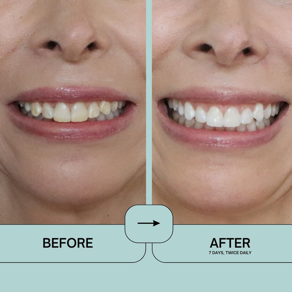 Applying Prostrips to left side of teeth