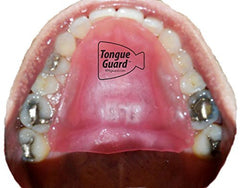 Custom-fit RPE Tongue Guard worn inside the mouth to protect the tongue from a dental expander