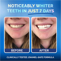 Teeth with sensitive gums whitened safely