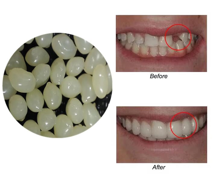 Sowsmile beads color 2 for temporary teeth repair