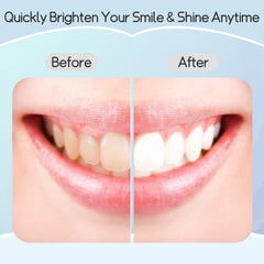 Bright, white smile after using Teeth Whitening Strips