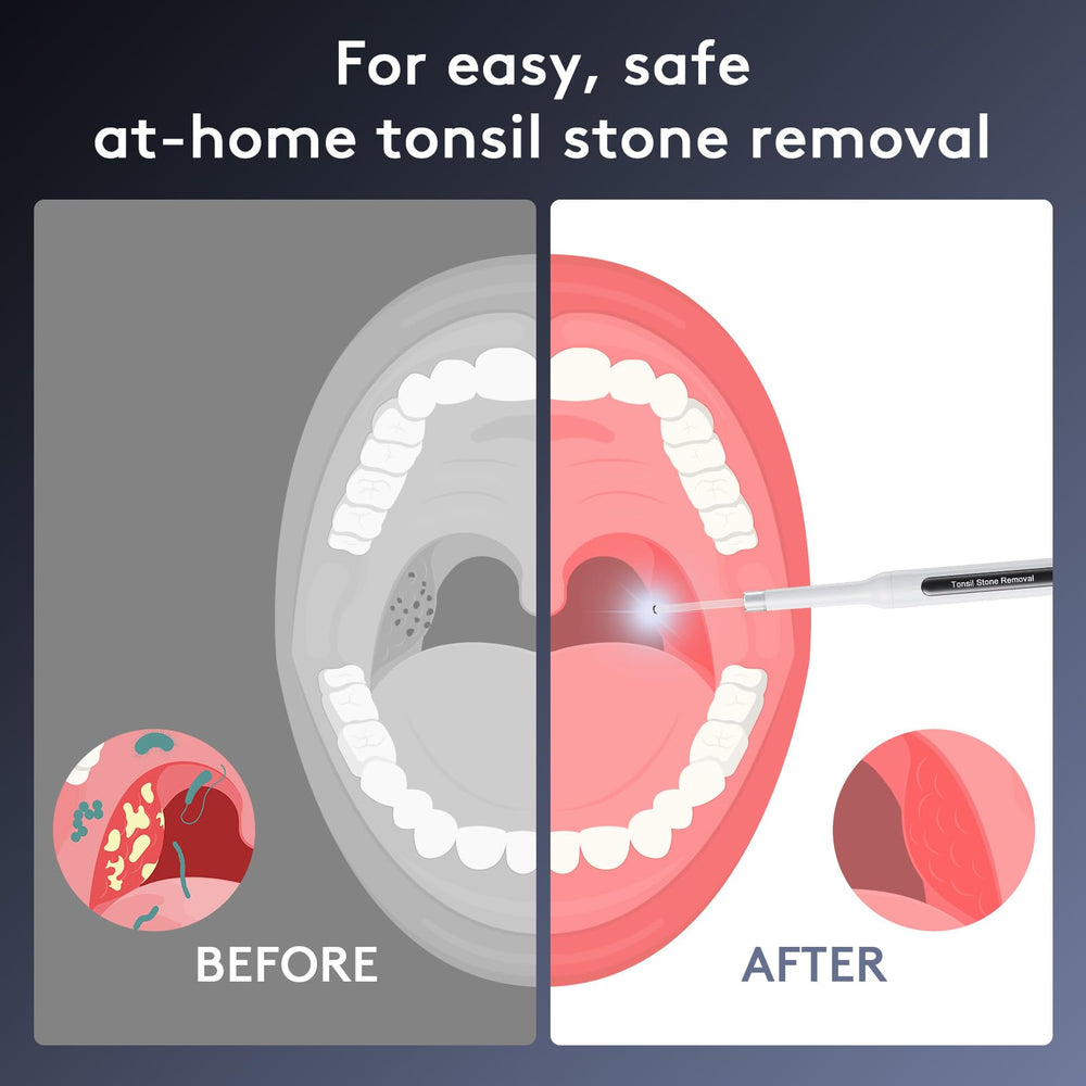 App interface showing WIFI connection for tonsil stone removal kit
