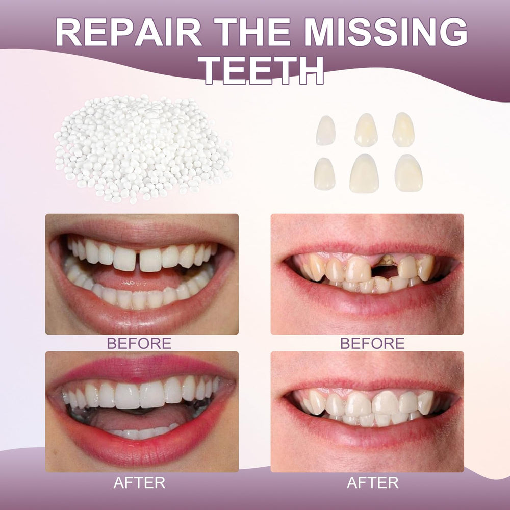 Colored tooth-matching pieces included in the kit