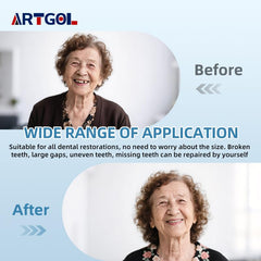 Temporary tooth fill applied to a gap in the upper jaw