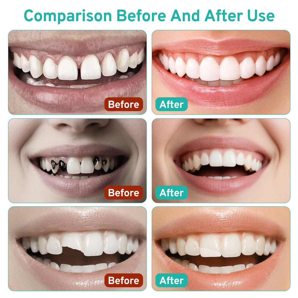 Applying the temporary tooth replacement