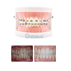 Low-profile ligature ties designed to fit under bracket wings and avoid gum irritation.