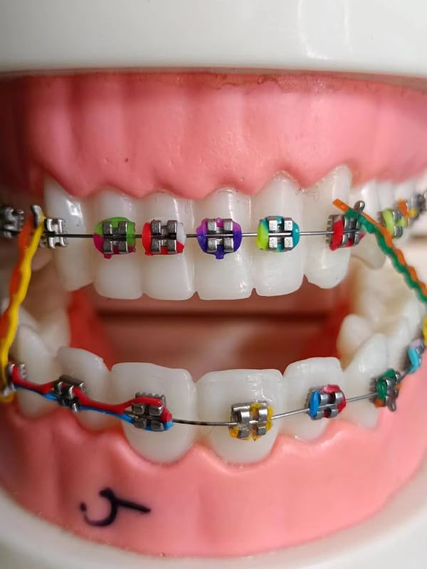 Purple and pink braces ligature ties for kids