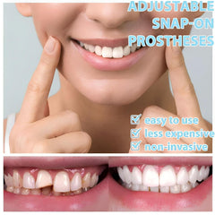 Natural and comfortable veneer kit for a better smile