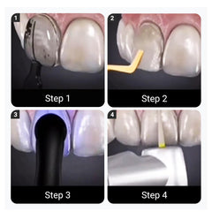 Complete 32-piece Wokyo veneers mould kit