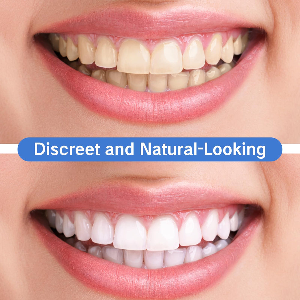 Easy-to-use snap-on dental covers for daily wear